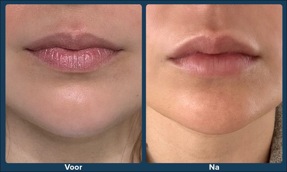 lipfiller voor na