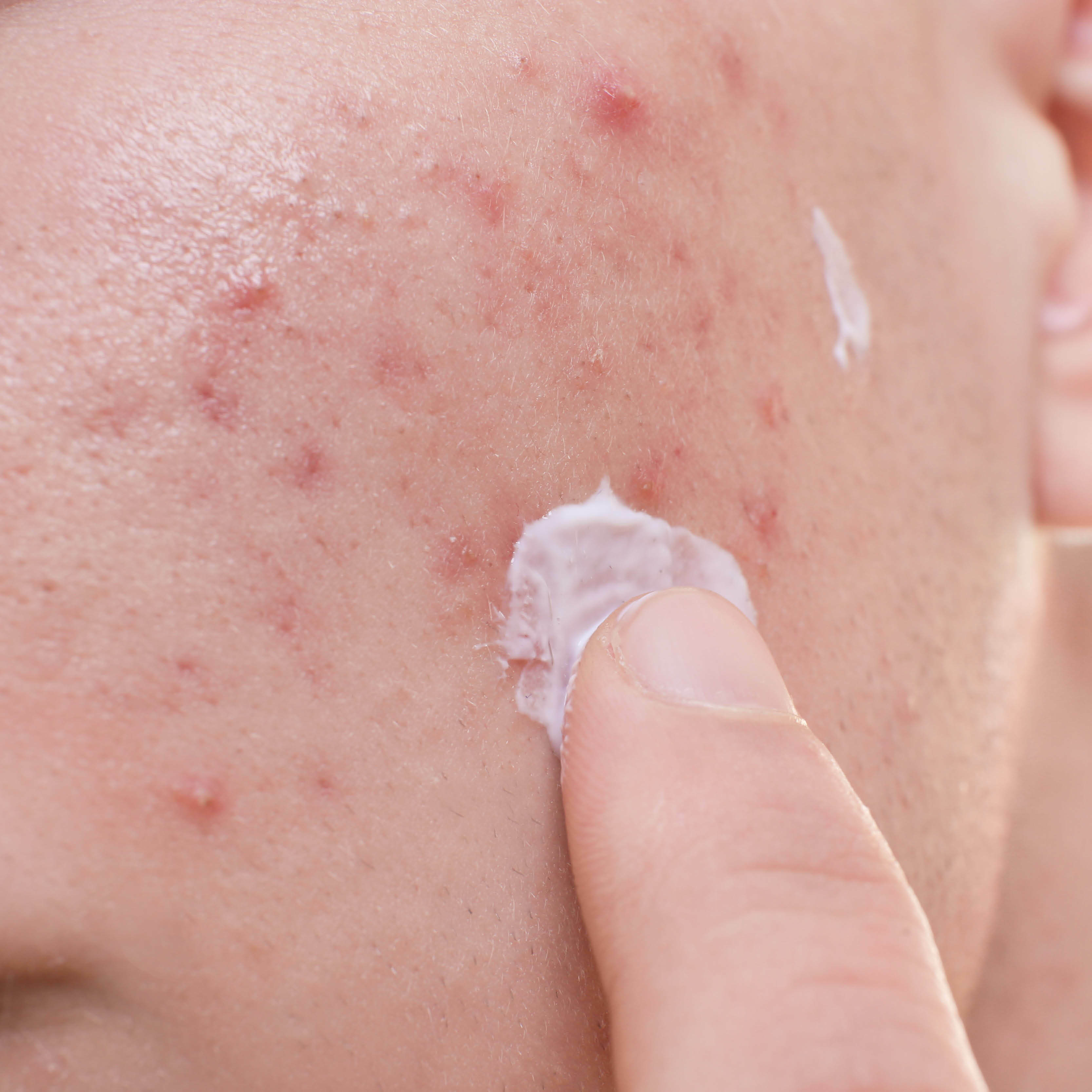 10 fabels en feiten over acne
