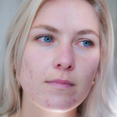 Behandeltraject acne: de ervaring van Hedy (27)