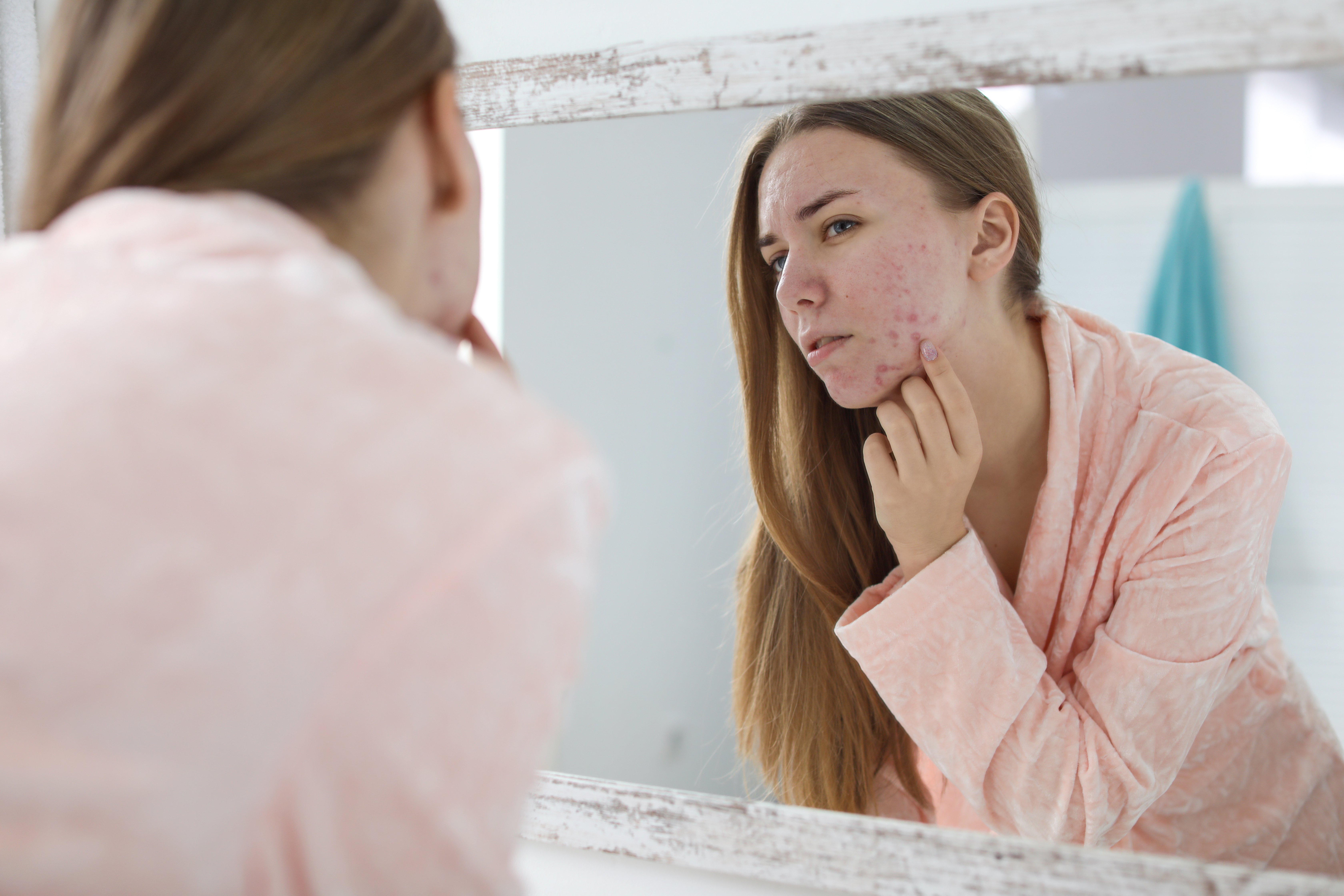 Hormonale acne: wat is het en wat kun je ertegen doen?