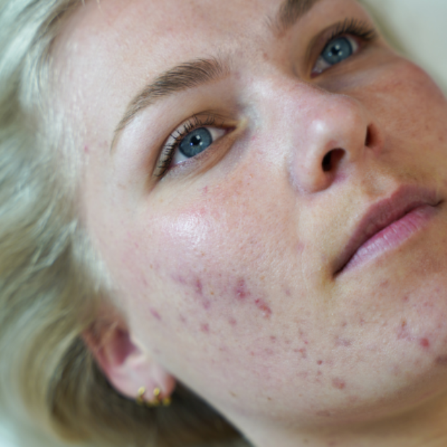 Acne Wat Is Het En Wat Kun Je Er Tegen Doen