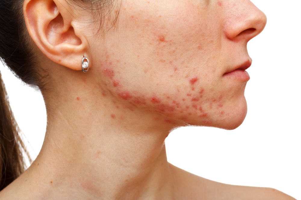 10 oorzaken van acne