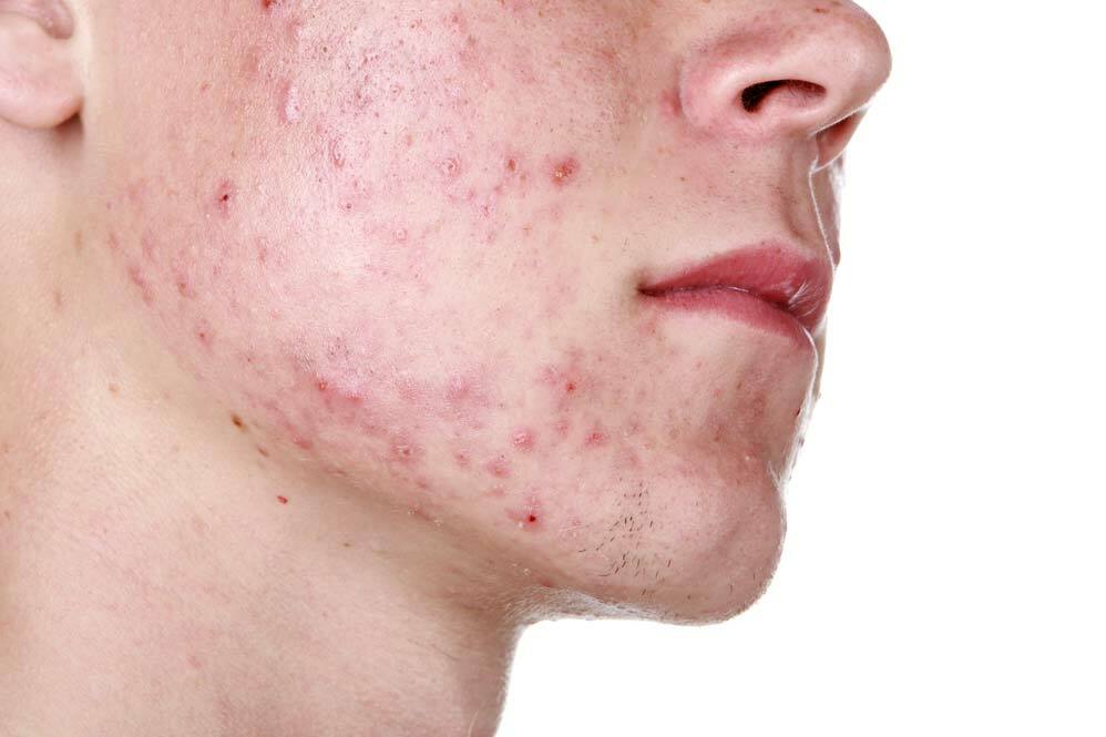 10 Fabels en feiten over acne