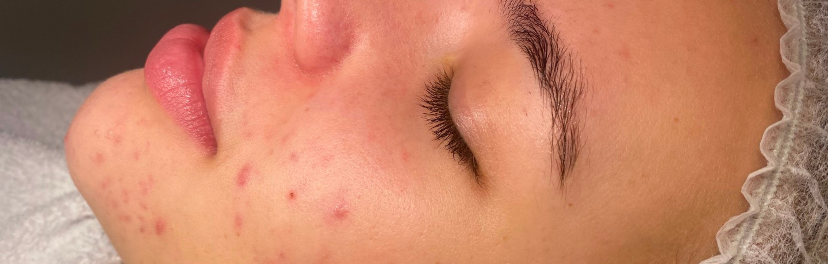 Behandeltraject acne: de ervaring van Dewi (20)