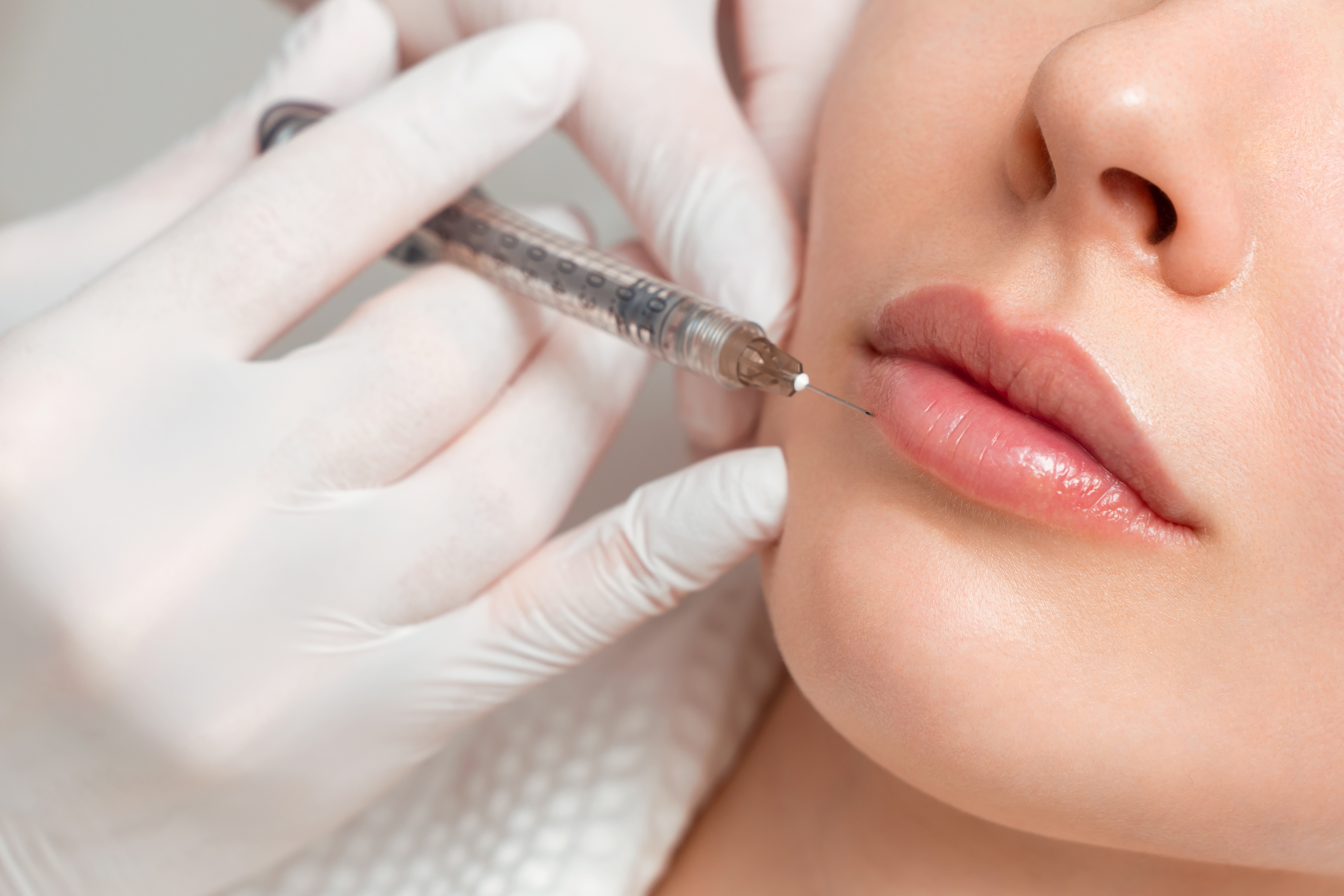Lipfillers: Voor vollere en natuurlijke lippen