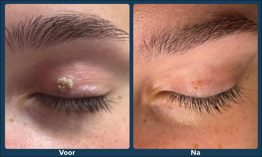 Fibroom op oog