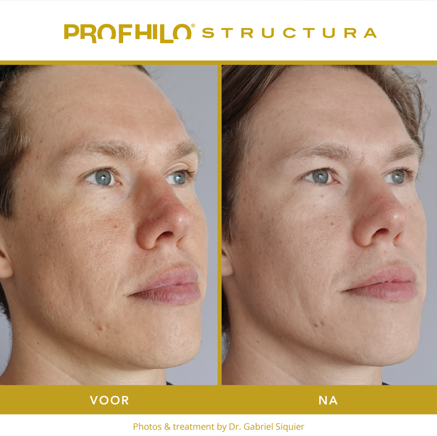 Profhilo Structura voor en na