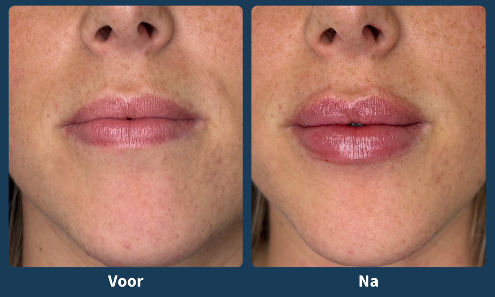 Voor en na lipfiller