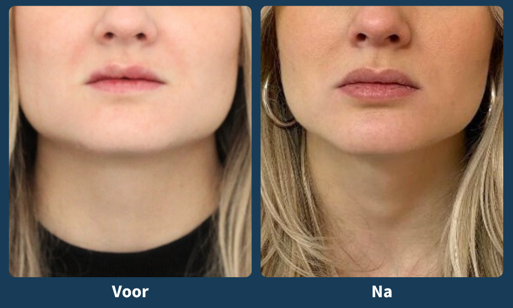 Voor- en na foto lipfillers
