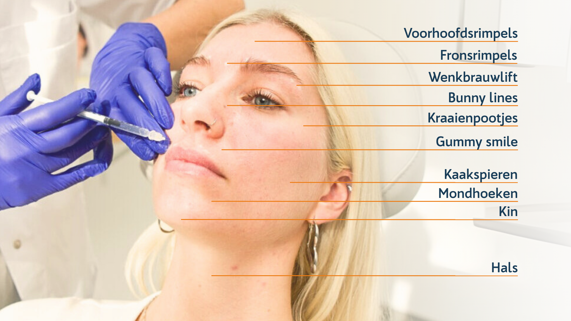 Botulinetoxine behandelzones
