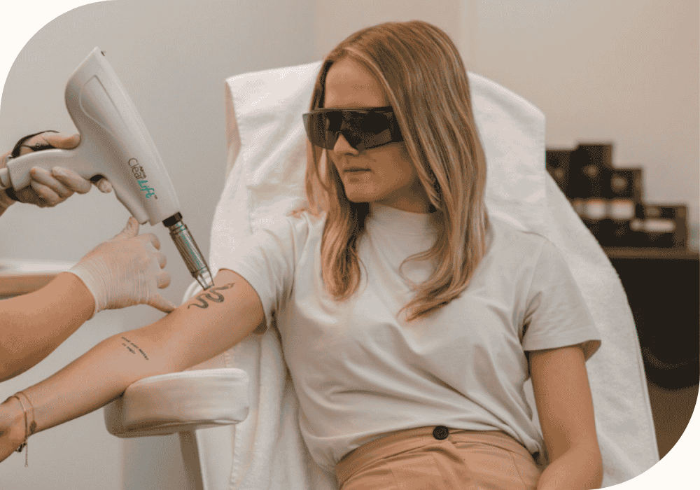 Tatoeage verwijderen