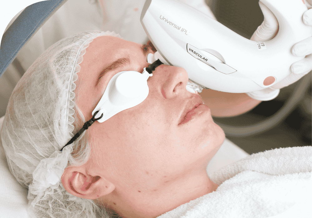 IPL Behandeling