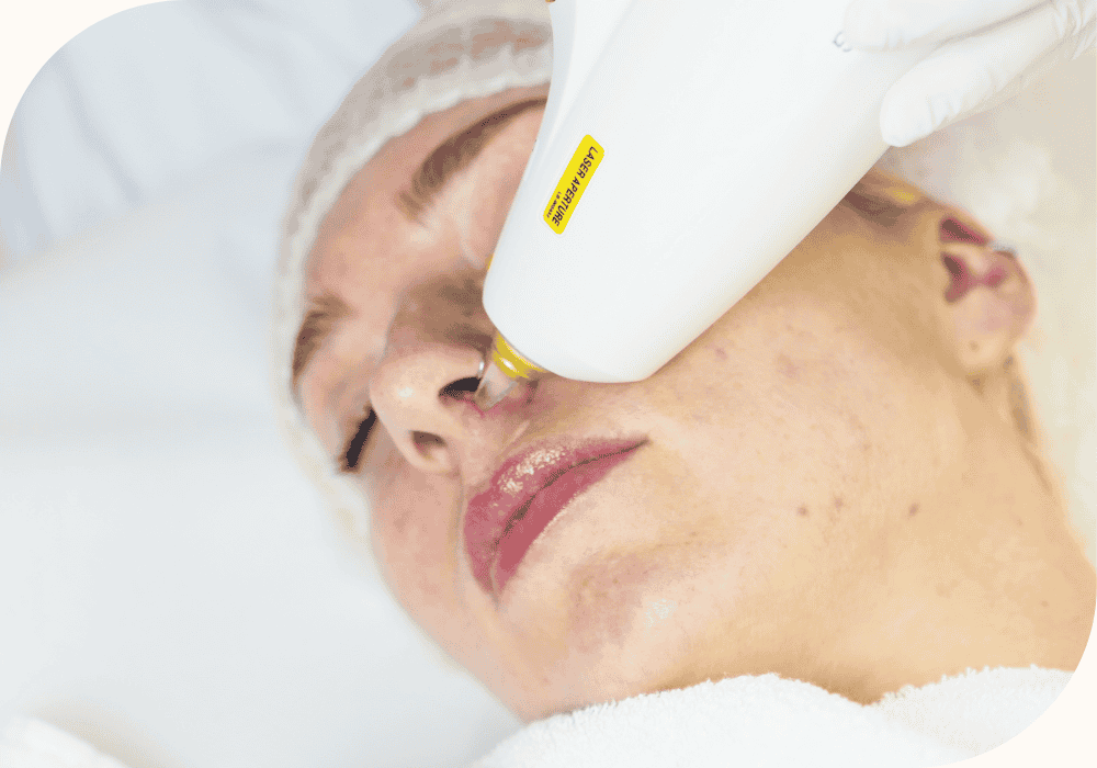 Long Pulsd Nd:Yag laser