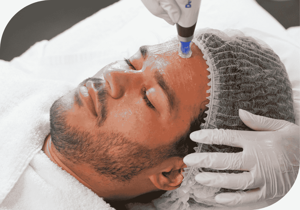 Microneedling