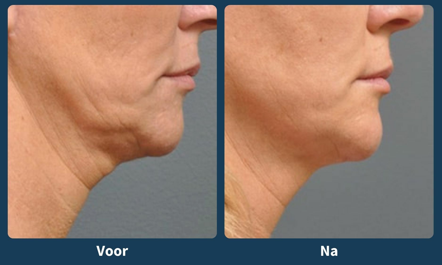 Voor en na Ultherapy PRIME behandeling