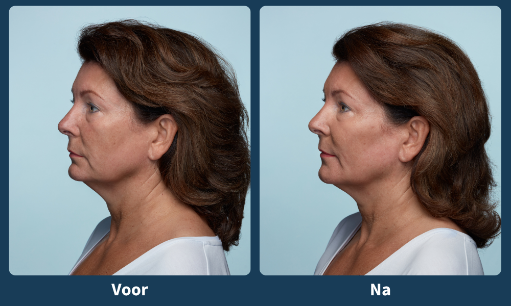 Voor- en na belotero