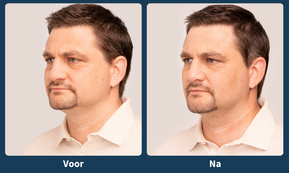 Voor- en nafoto