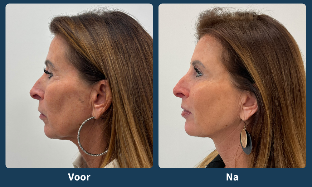 Voor en na full face