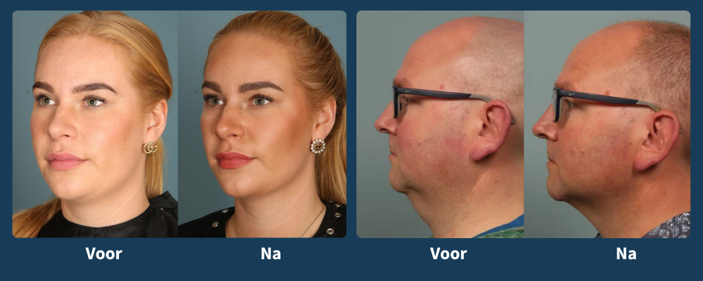 Voor en na CoolSculpting®