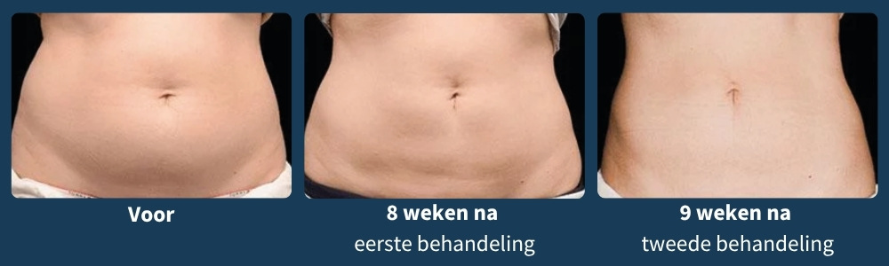 Voor en na CoolSculpting®
