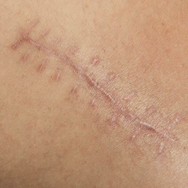 Litteken behandeling De Huidkliniek